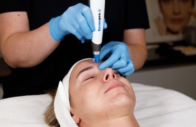 Microneelding behandeling bij Dehcos met Dermapen 4