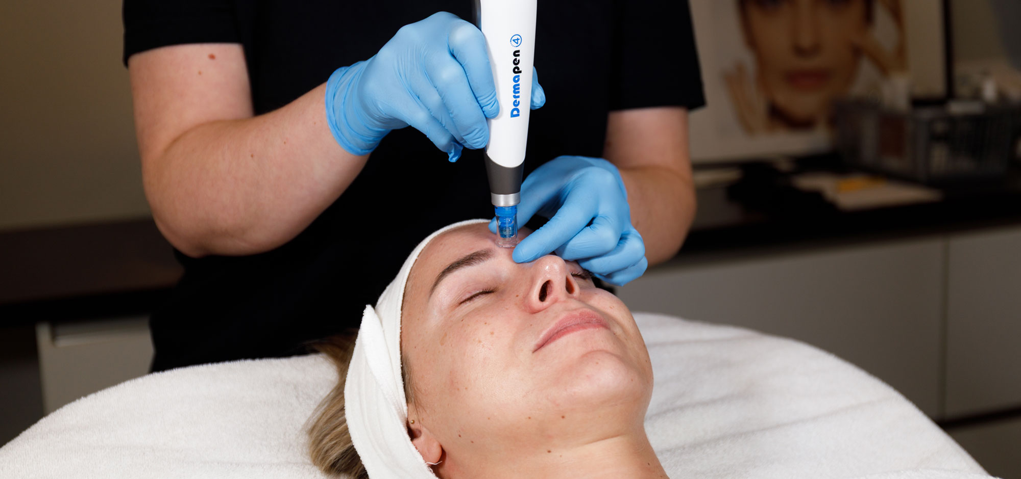 Microneelding behandeling bij Dehcos met Dermapen 4